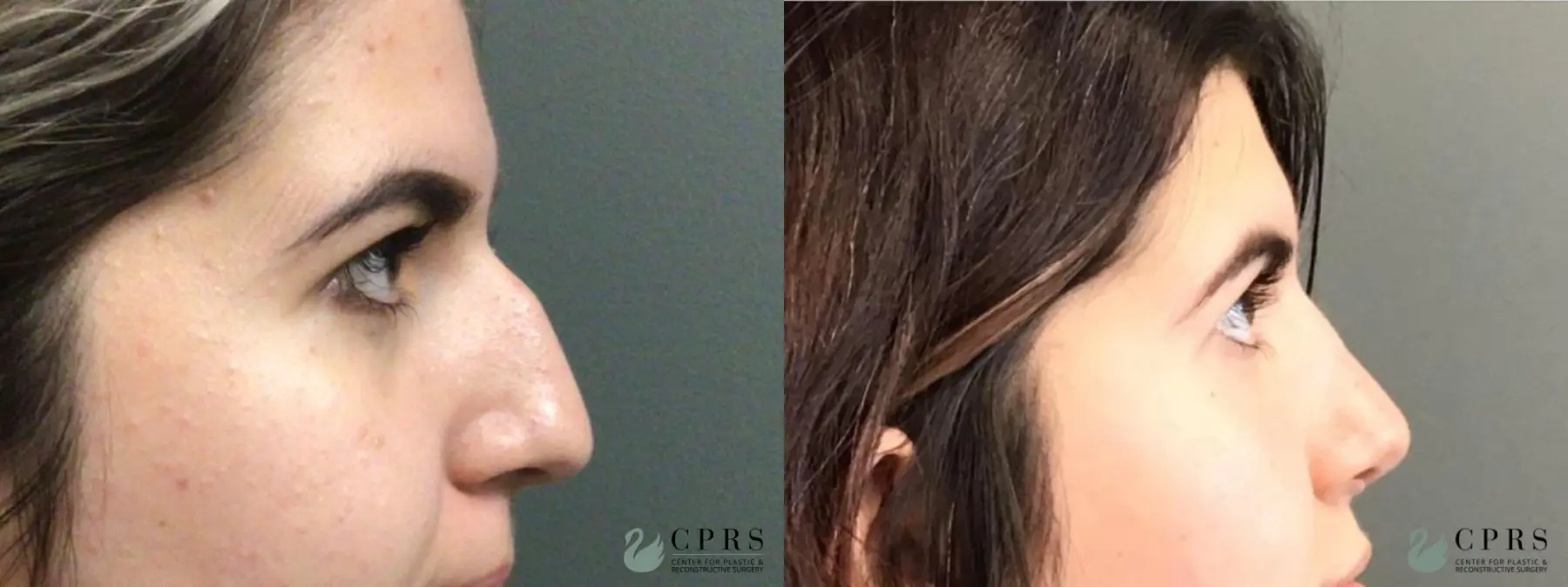Rhinoplasty: Patient 14 - Before and After 3