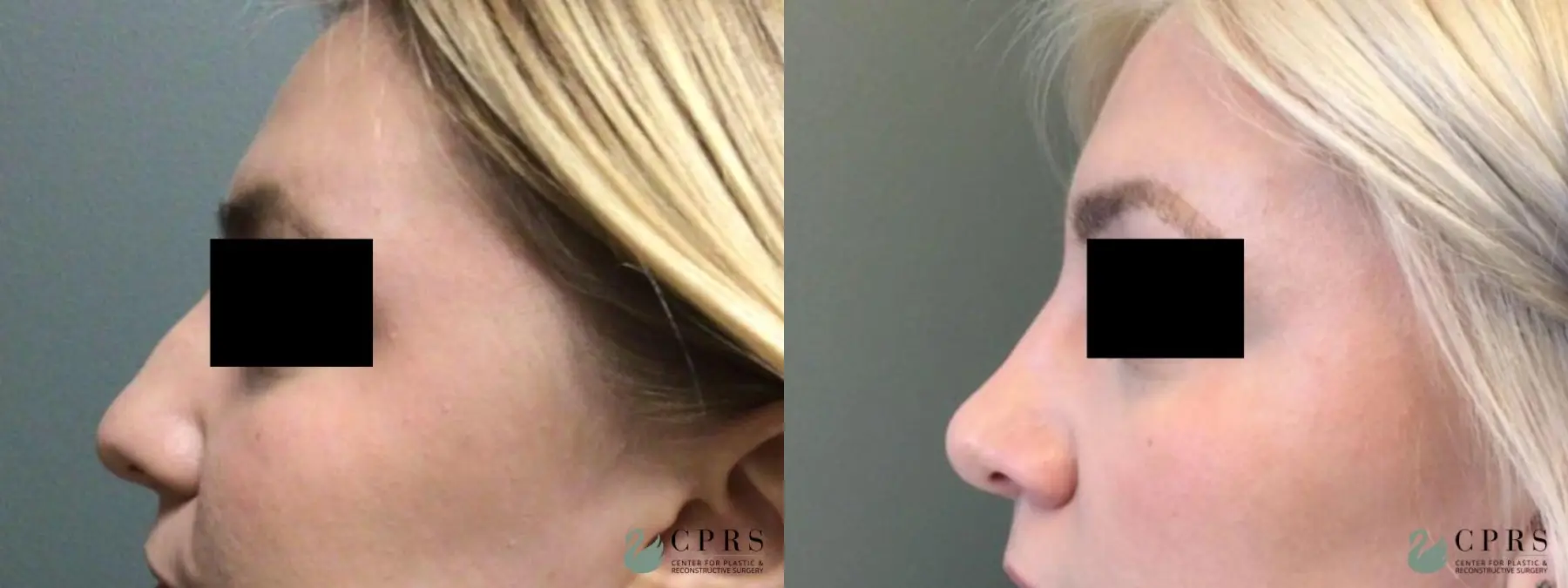Rhinoplasty: Patient 6 - Before and After 3
