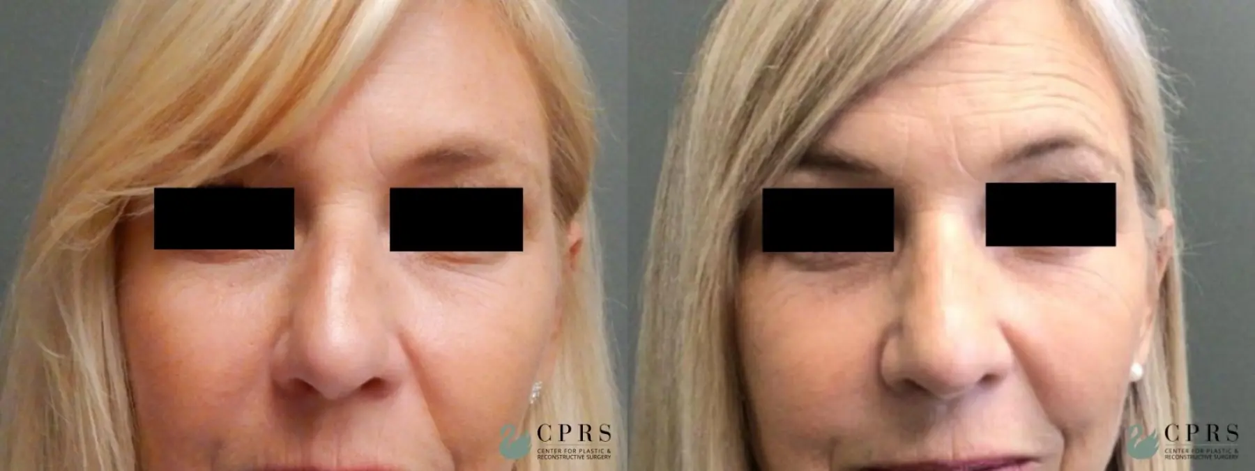 Rhinoplasty: Patient 12 - Before and After  