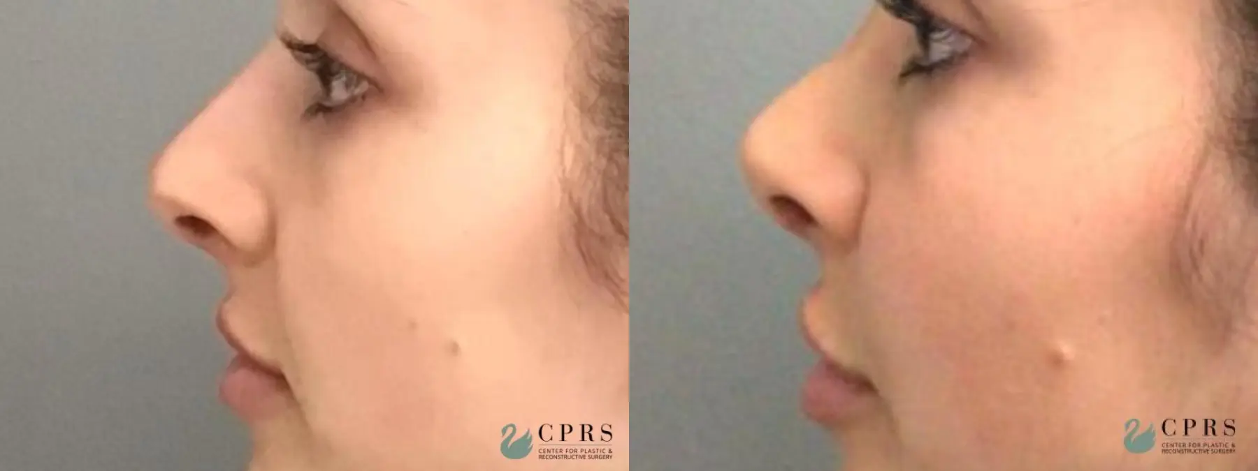 Rhinoplasty: Patient 6 - Before and After  