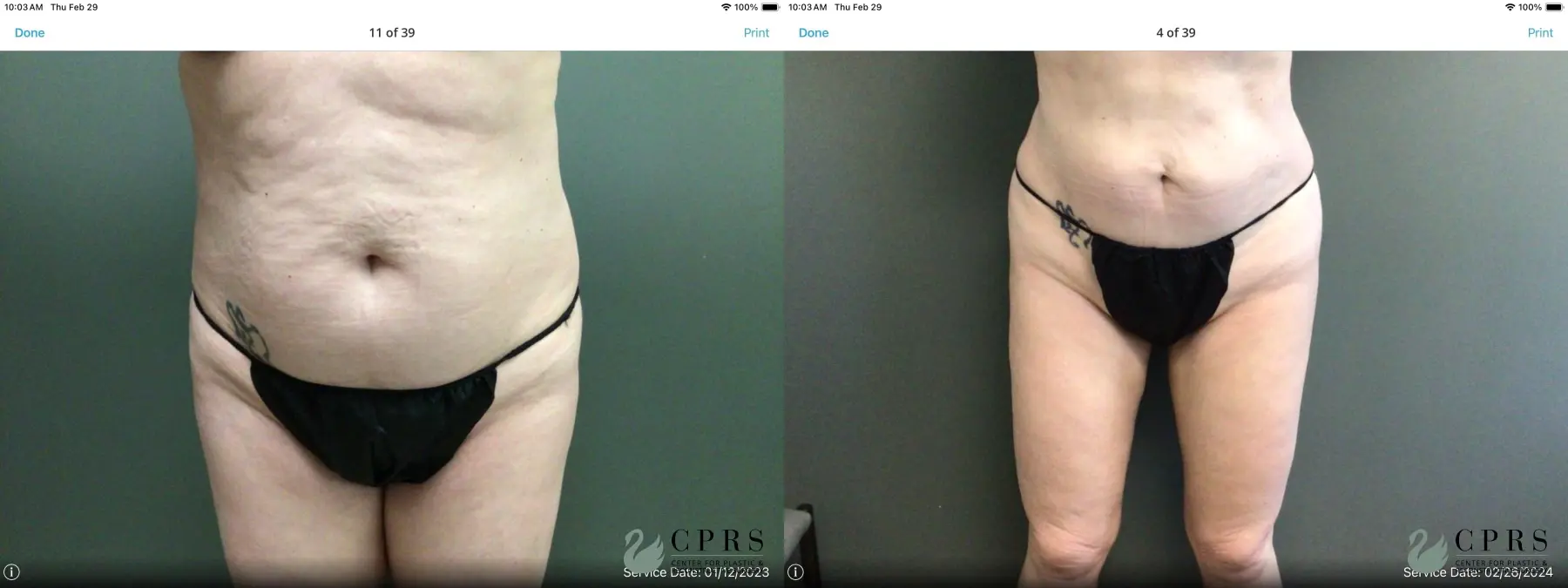 VASER® Lipo: Patient 1 - Before and After  