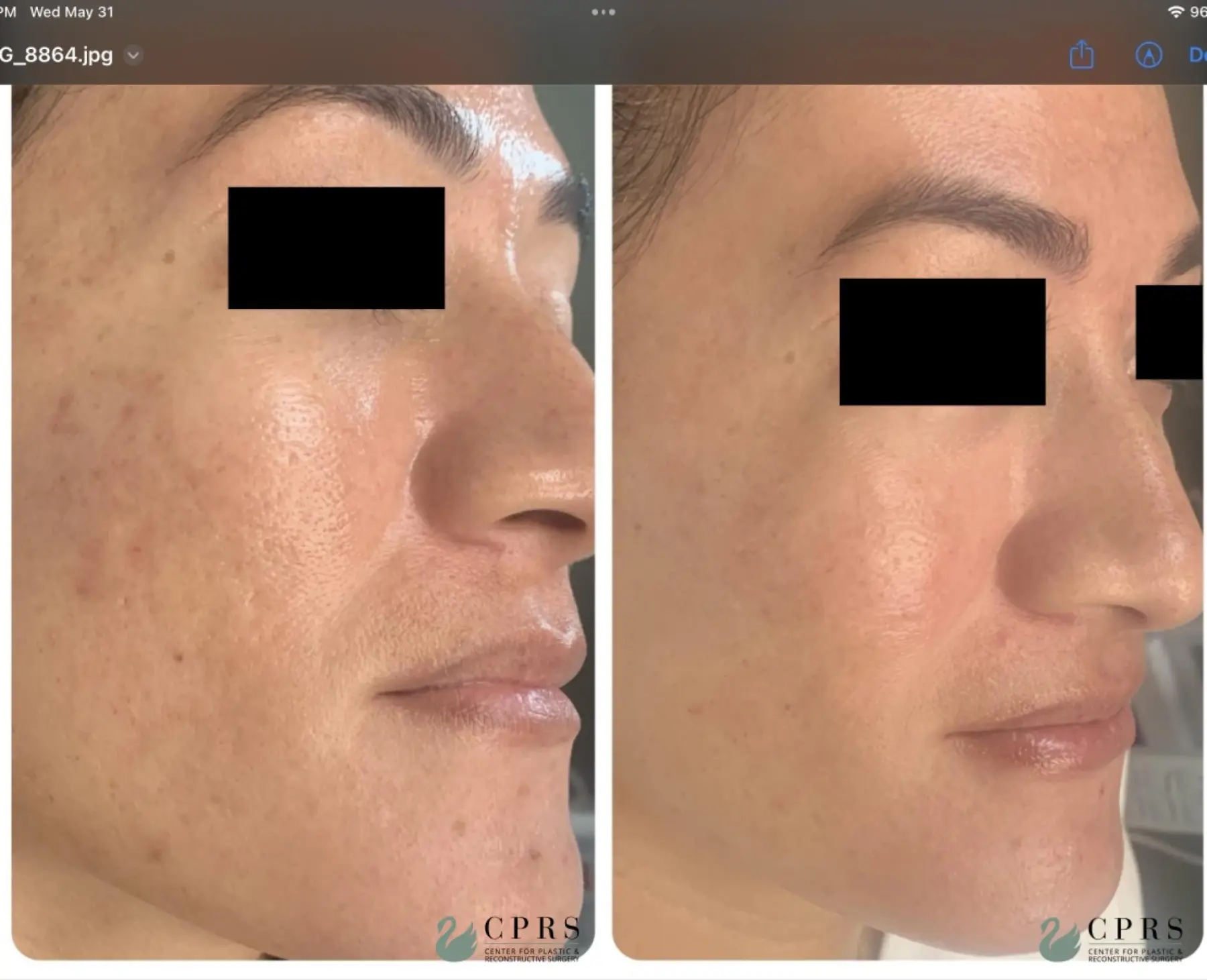 VI Peel : Patient 2 - Before and After 1