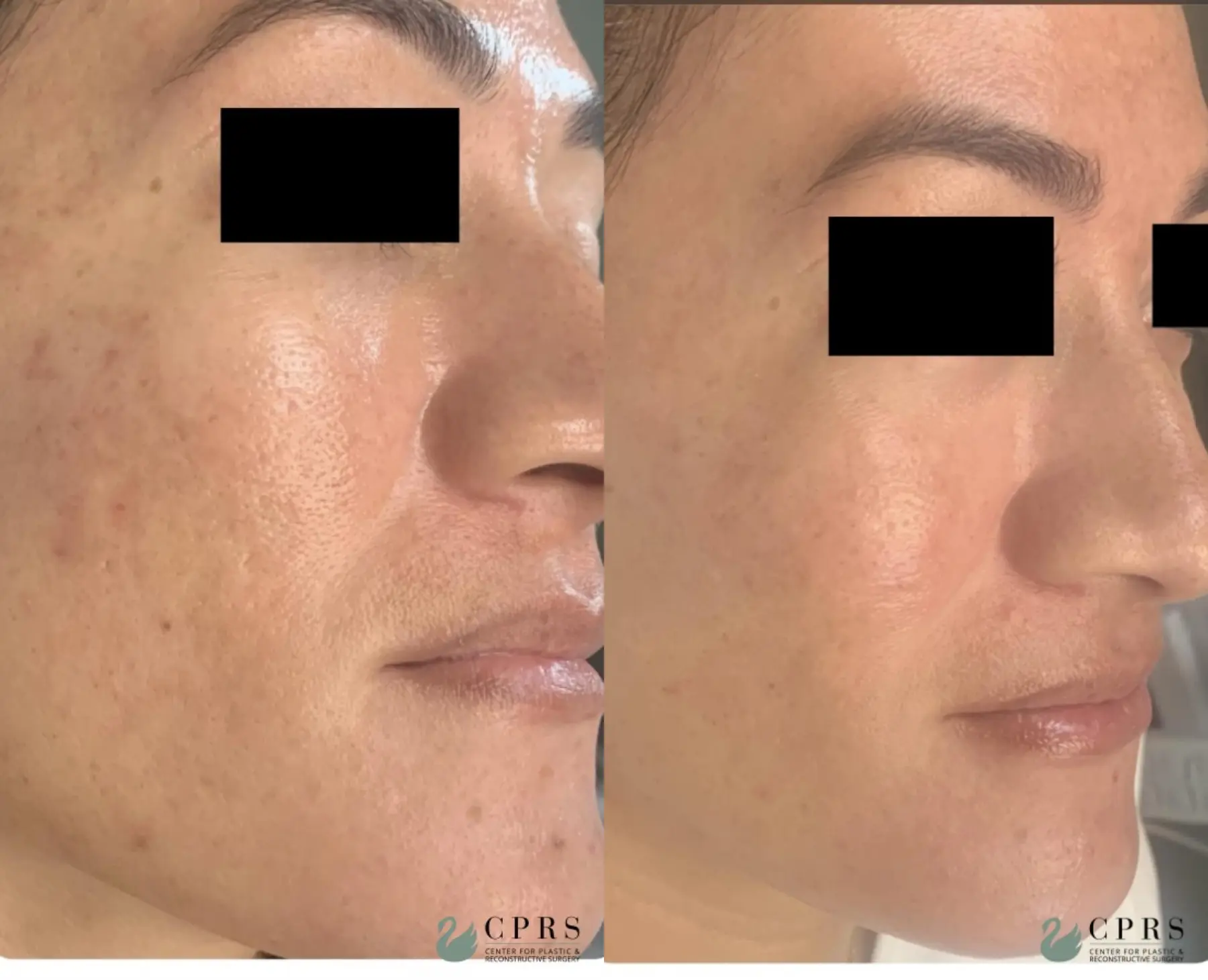 VI Peel : Patient 2 - Before and After  