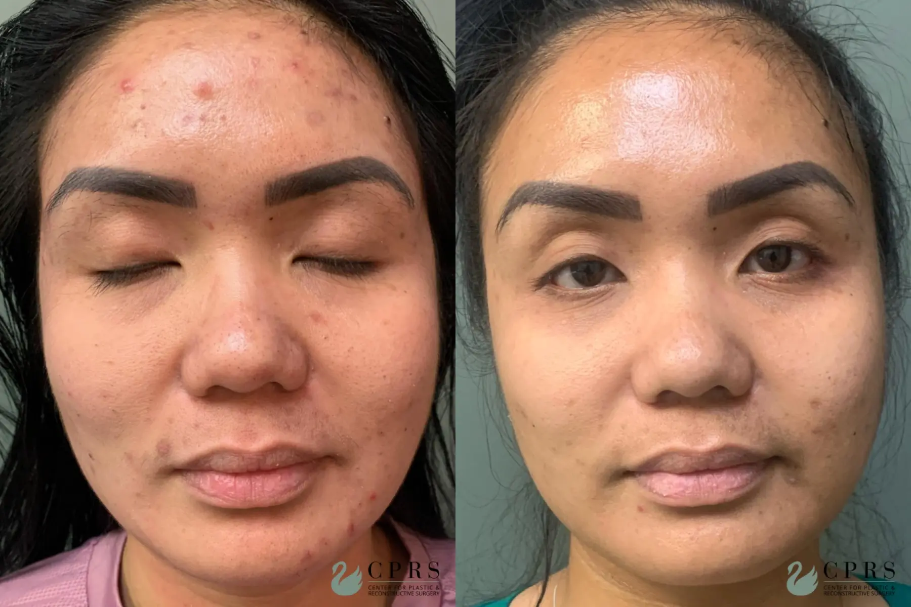 VI Peel : Patient 1 - Before and After  