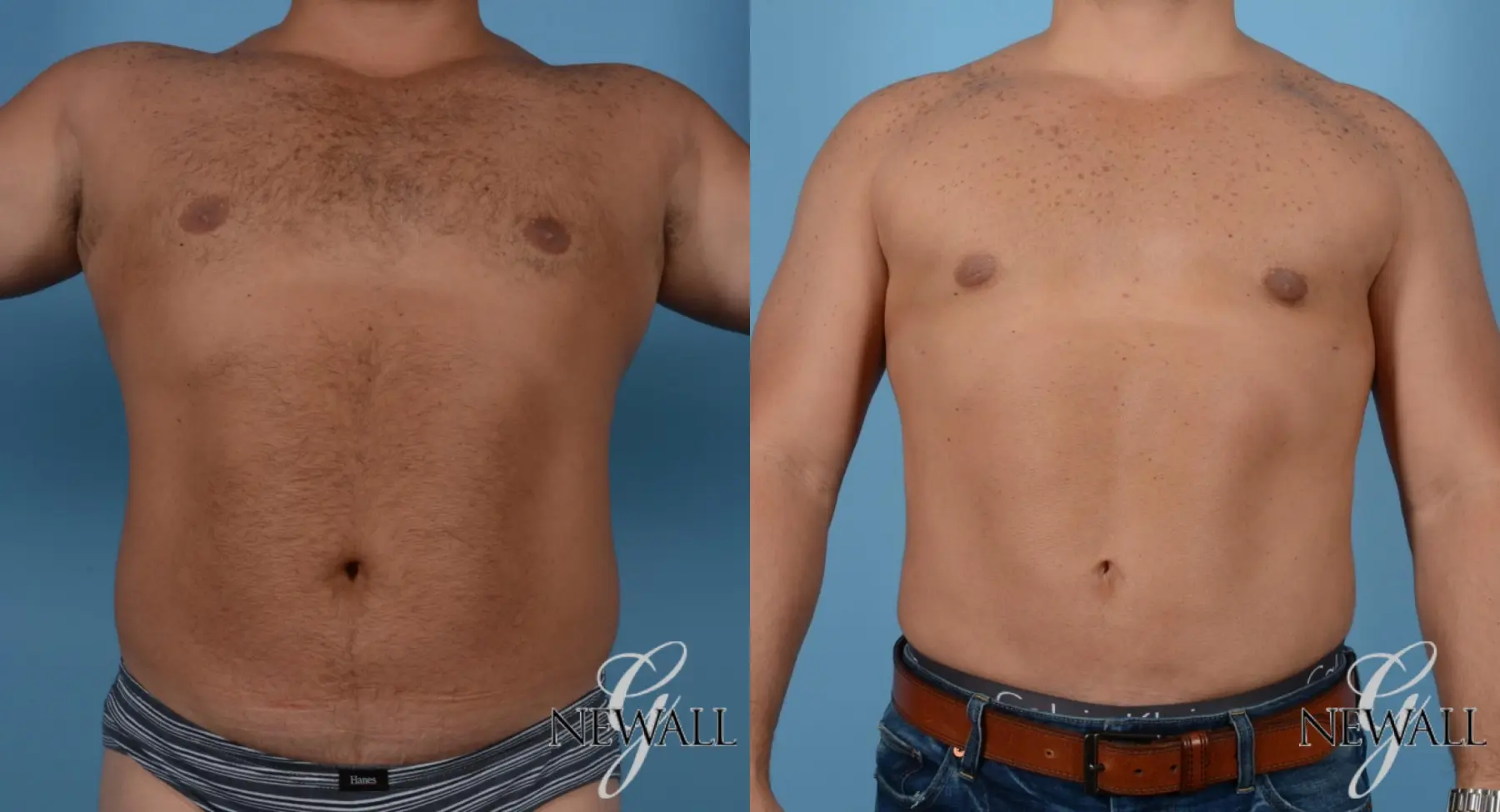 Abdominal-etching-for-men: Patient 2 - Before and After  