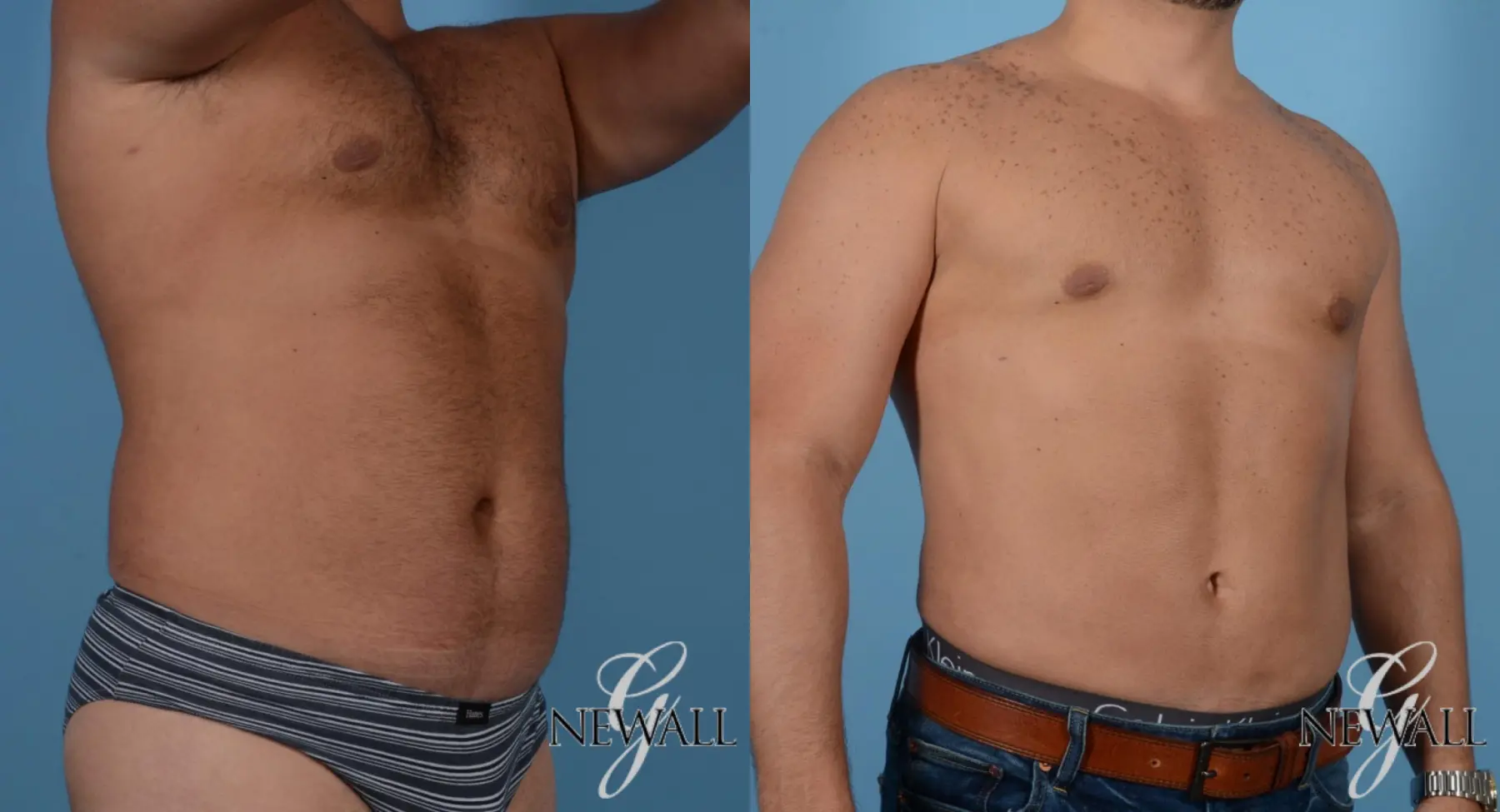 Man Shares Abdominal Etching Surgery Before and After Photos