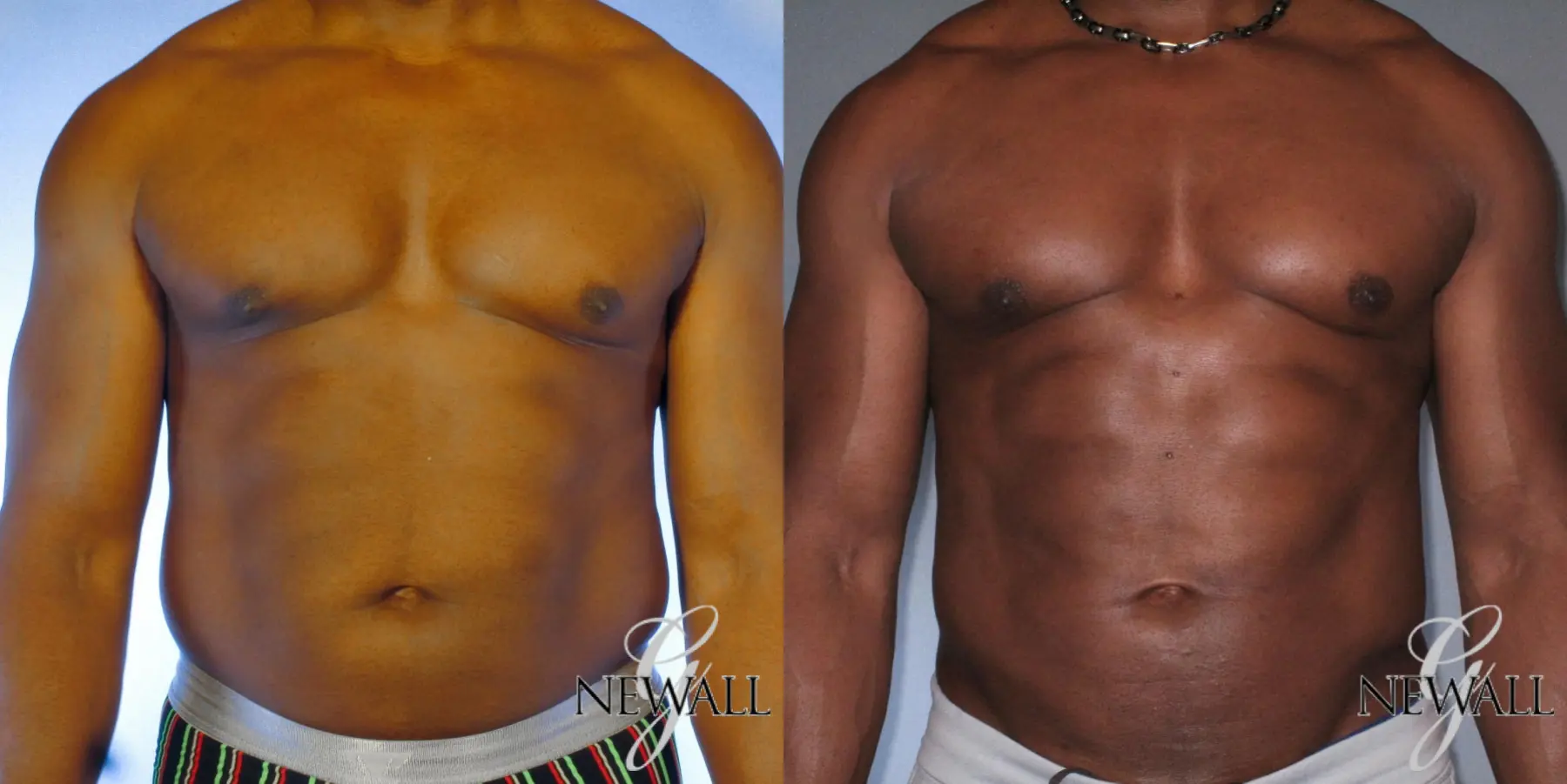 Abdominal-etching-for-men: Patient 1 - Before and After  