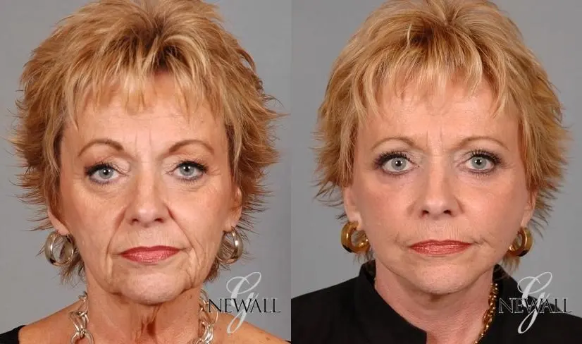 Blepharoplasty: Patient 8 - Before and After  