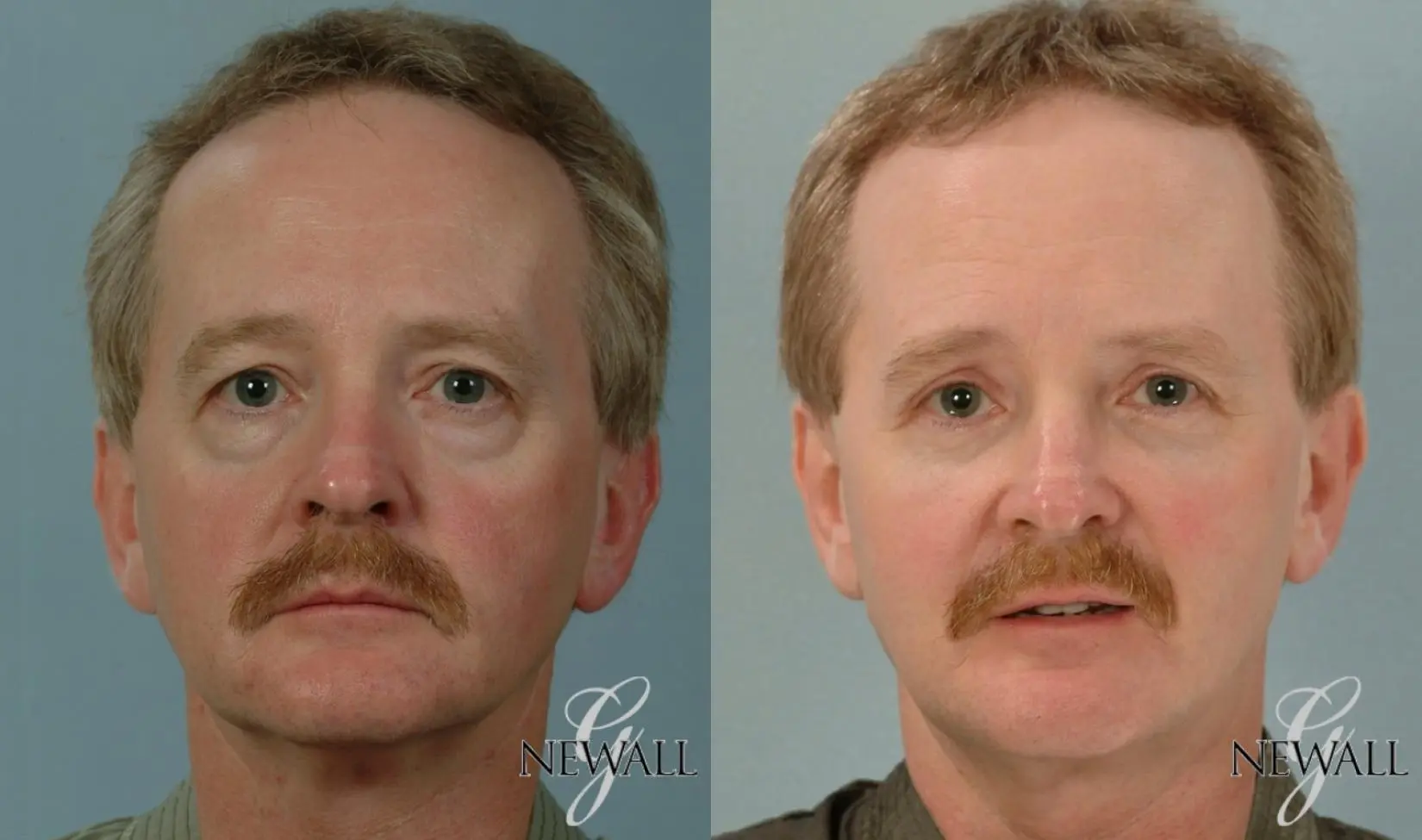 Blepharoplasty-for-men: Patient 2 - Before and After  