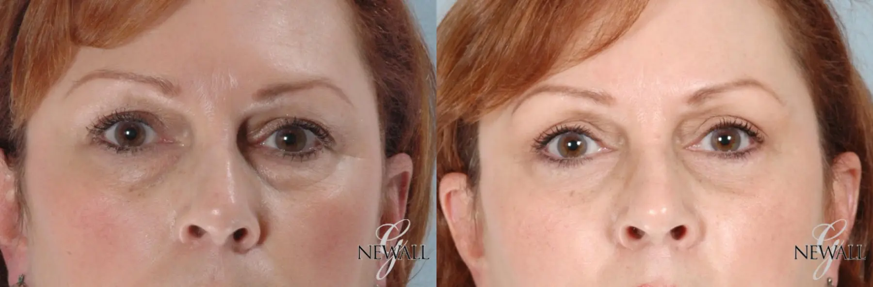 Blepharoplasty: Patient 4 - Before and After  