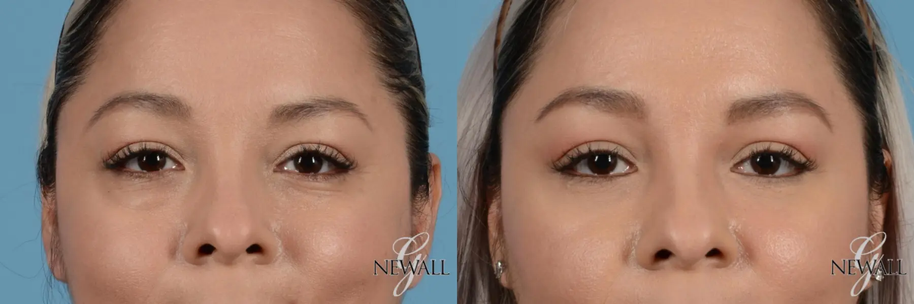 Blepharoplasty: Patient 2 - Before and After  