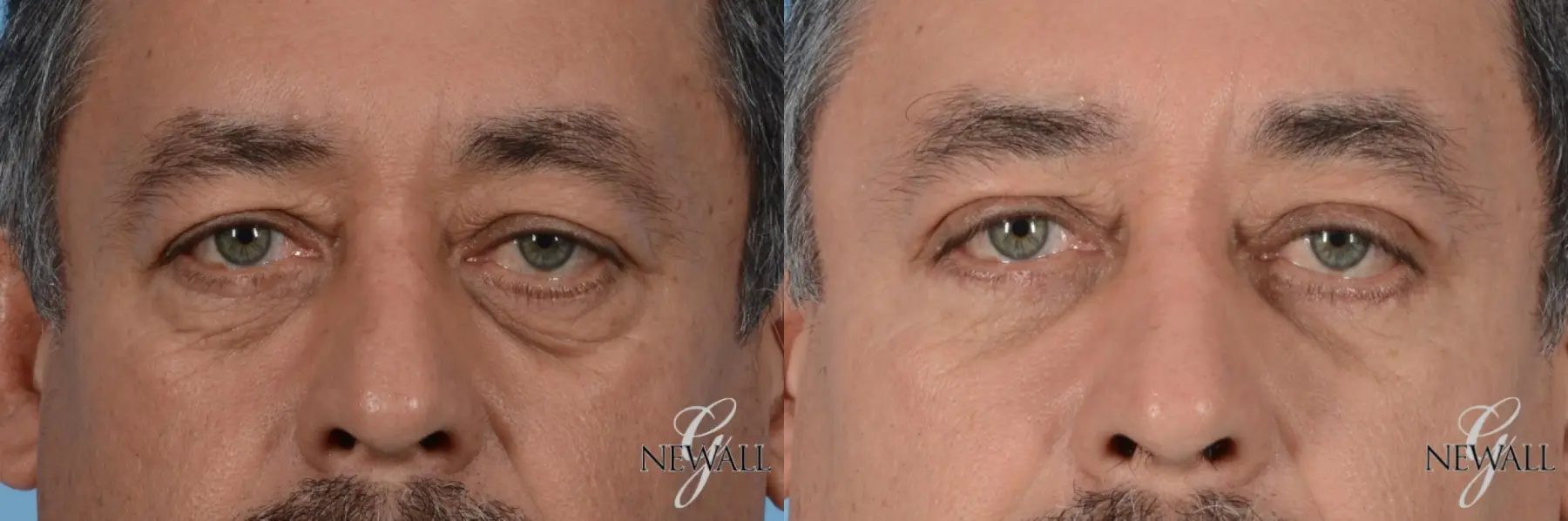 Blepharoplasty-for-men: Patient 1 - Before and After  