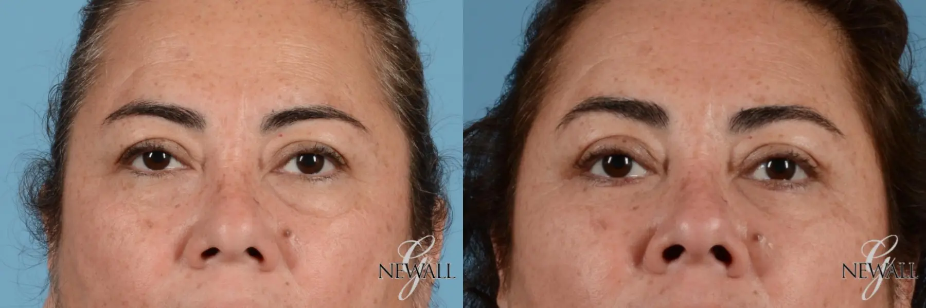 Blepharoplasty: Patient 3 - Before and After  