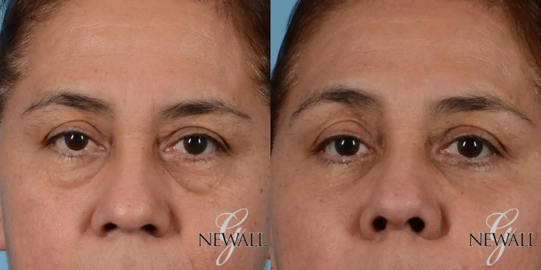 Blepharoplasty: Patient 6 - Before and After  