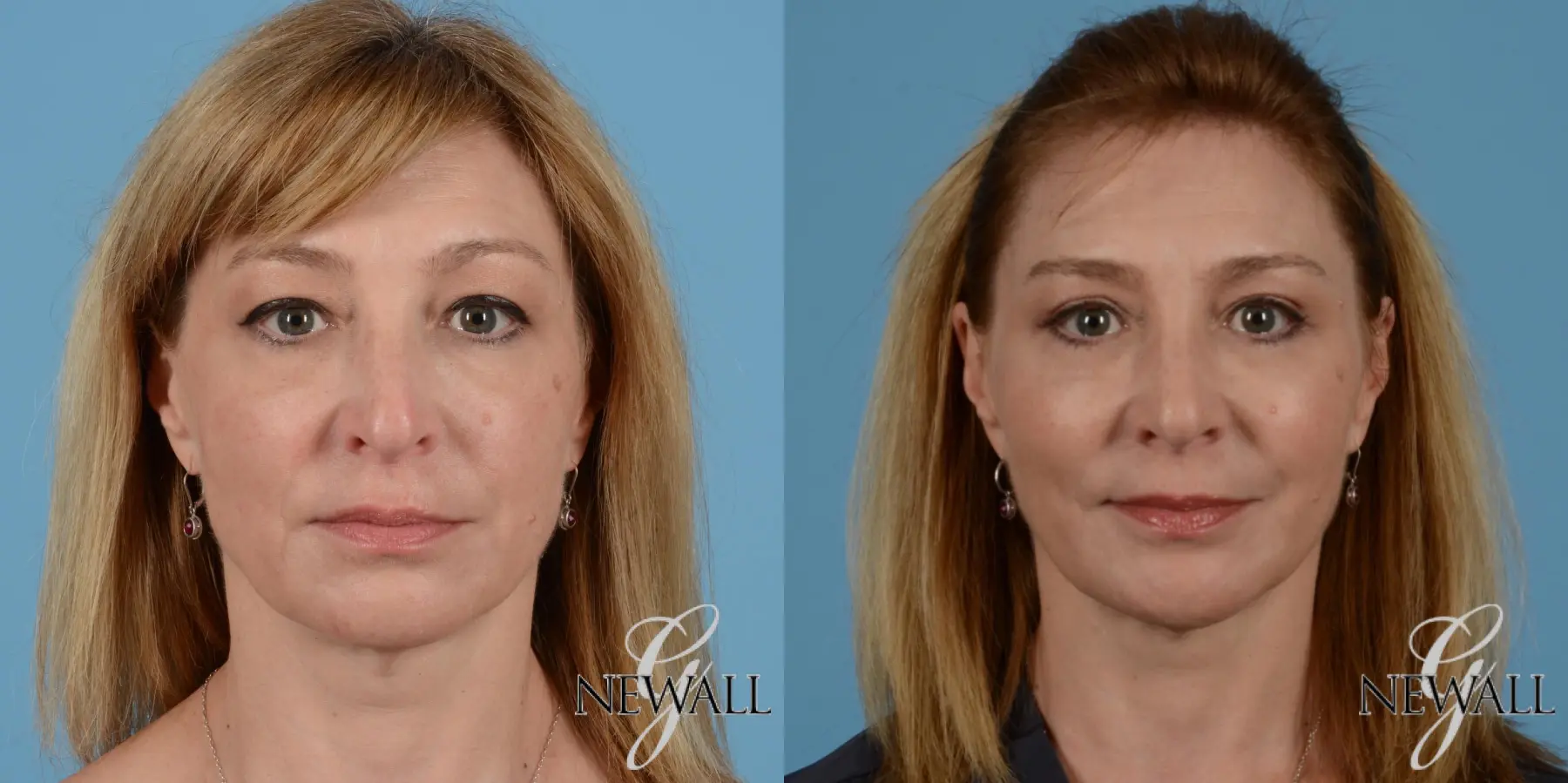 Blepharoplasty: Patient 5 - Before and After  