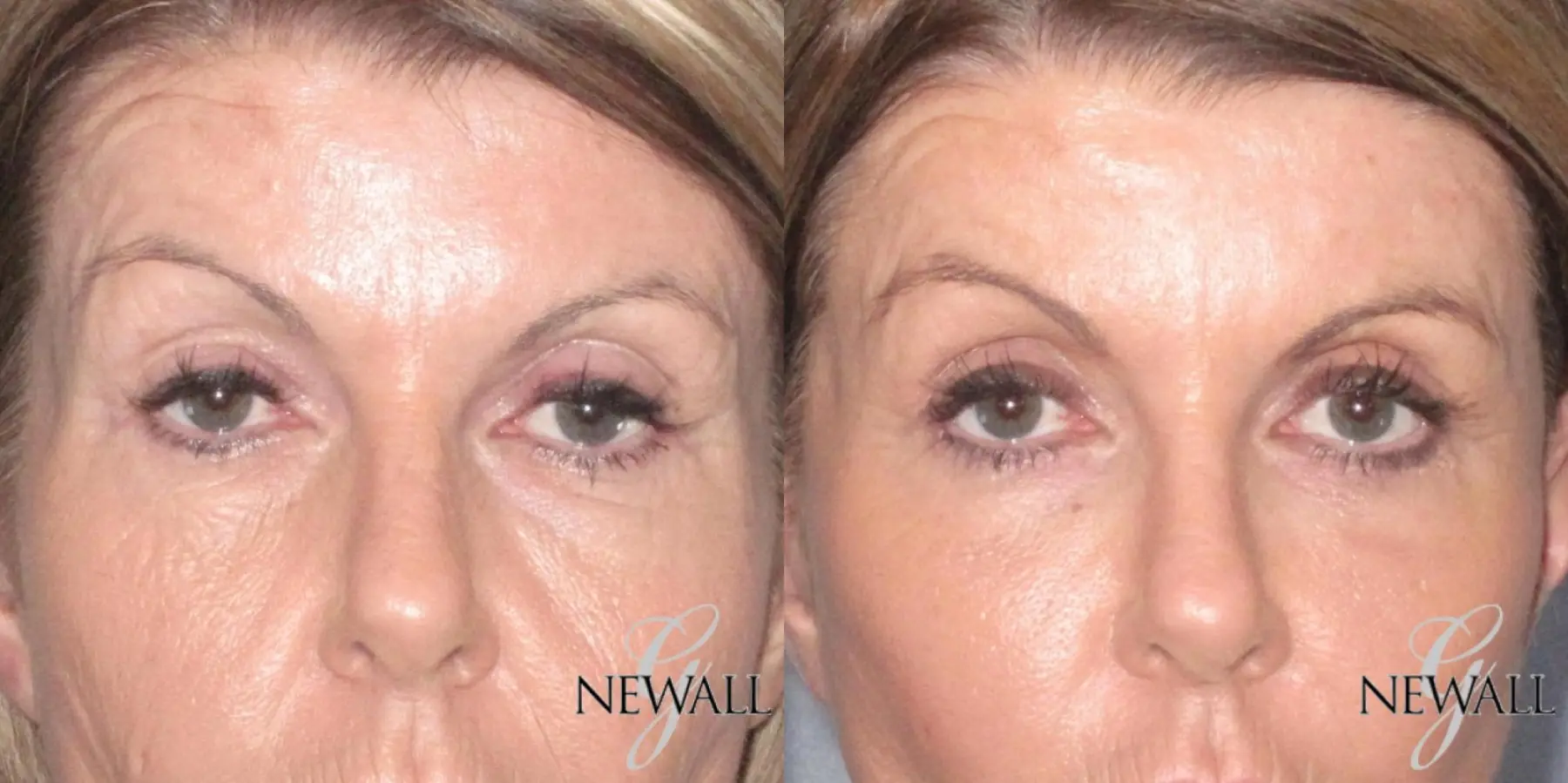 Blepharoplasty: Patient 7 - Before and After  