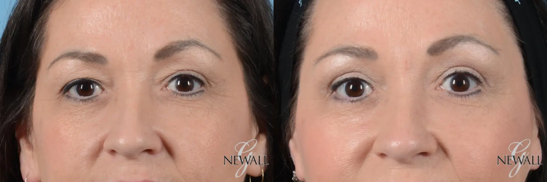 Blepharoplasty: Patient 1 - Before and After  