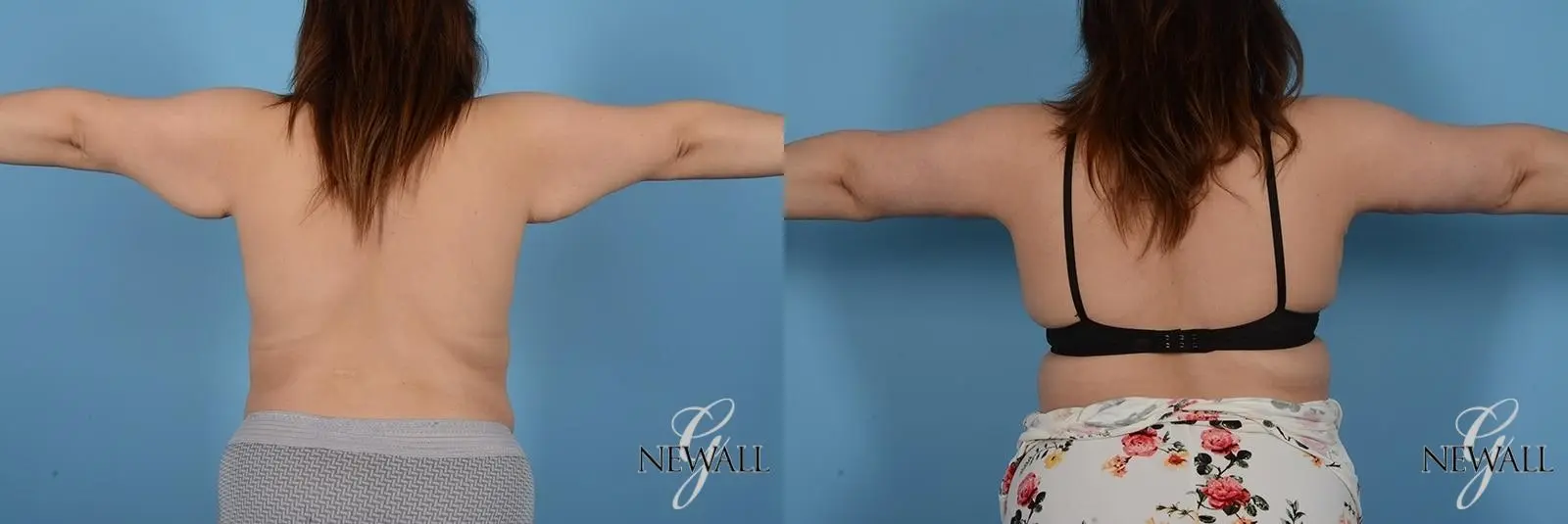 Brachioplasty: Patient 2 - Before and After  
