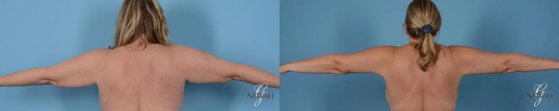 Brachioplasty: Patient 1 - Before and After  