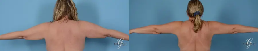 Brachioplasty: Patient 1 - Before and After  