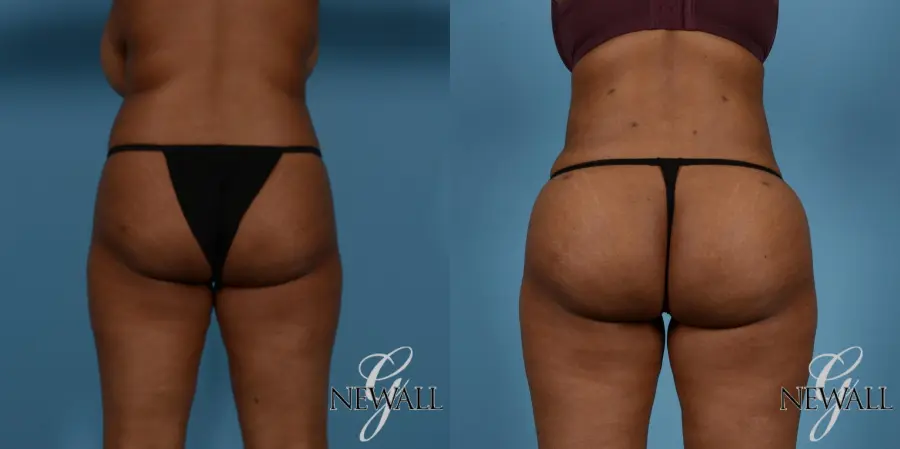 Brazilian Butt Lift: Patient 5 - Before and After  