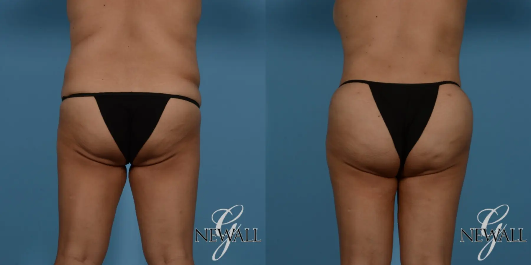 Brazilian Butt Lift: Patient 3 - Before and After  