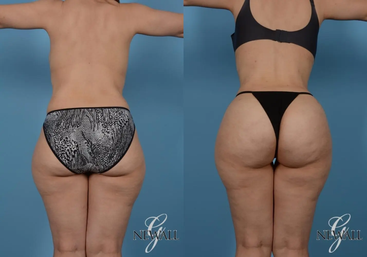 Brazilian Butt Lift: Patient 4 - Before and After  