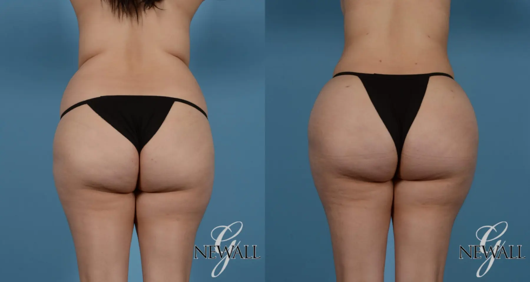 Houston, Sugar Land, TXBrazilian Butt Lift Before & After Gallery