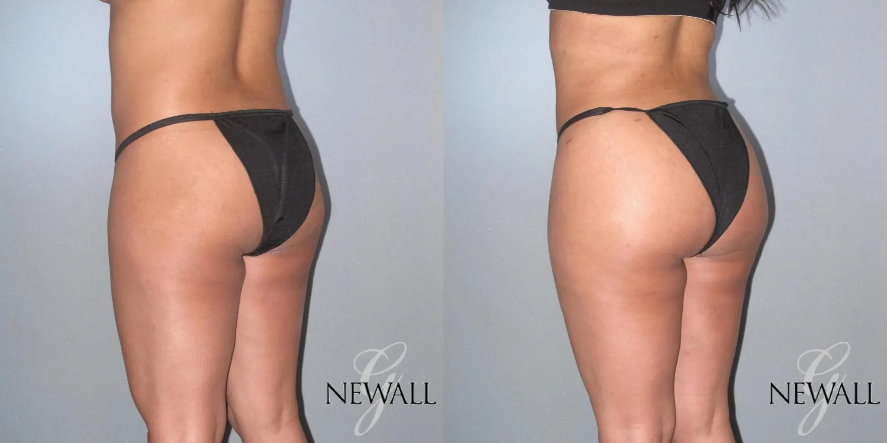 Brazilian Butt Lift: Patient 6 - Before and After  