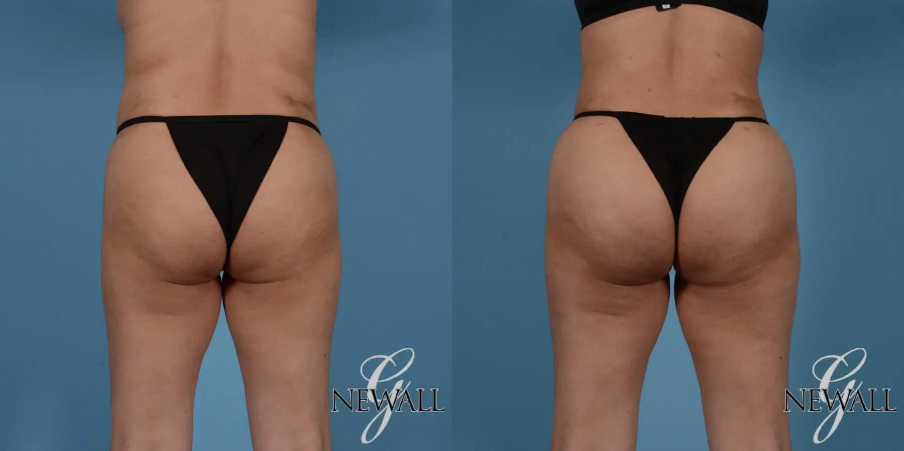 Brazilian Butt Lift: Patient 7 - Before and After  