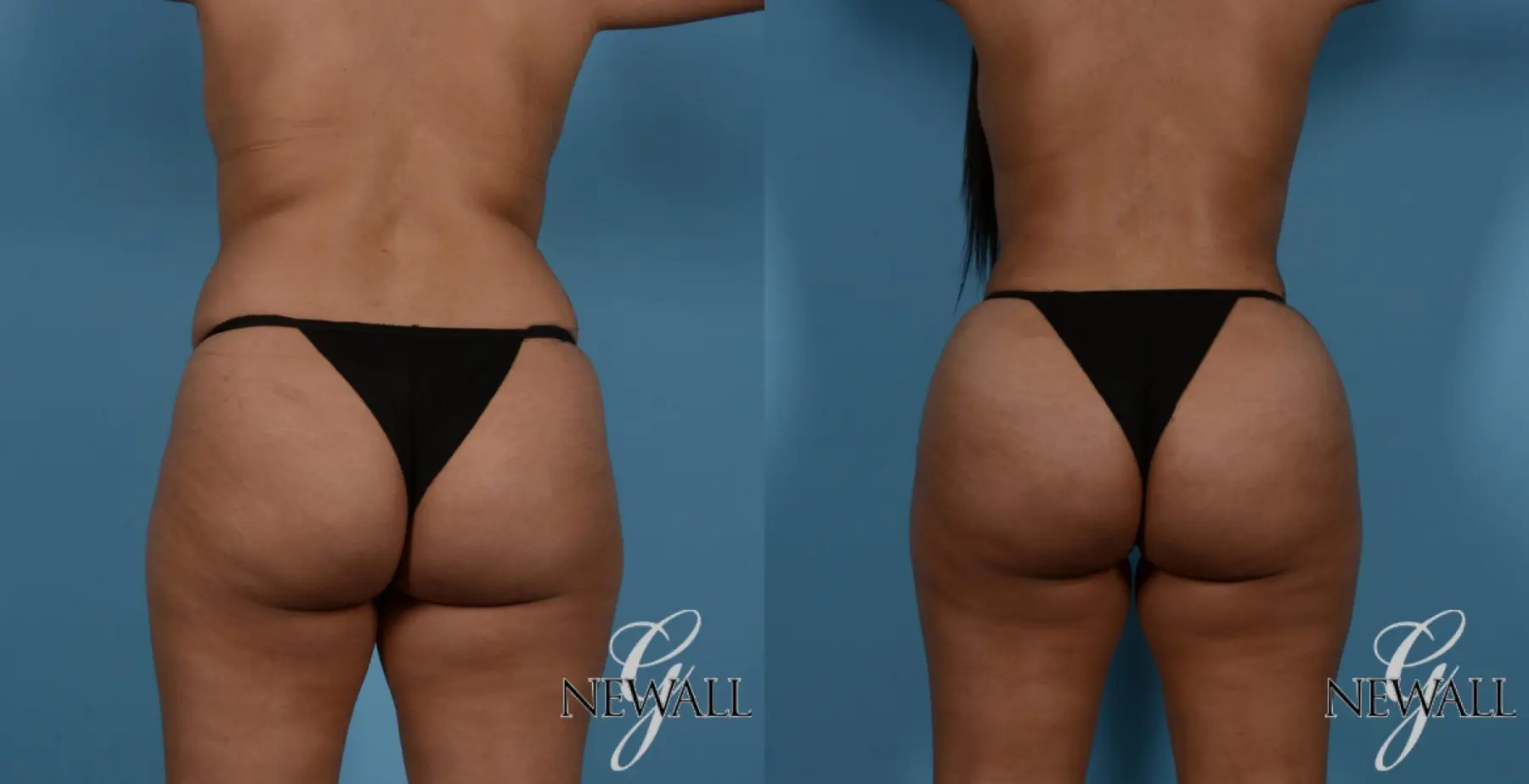 Brazilian Butt Lift: Patient 2 - Before and After  