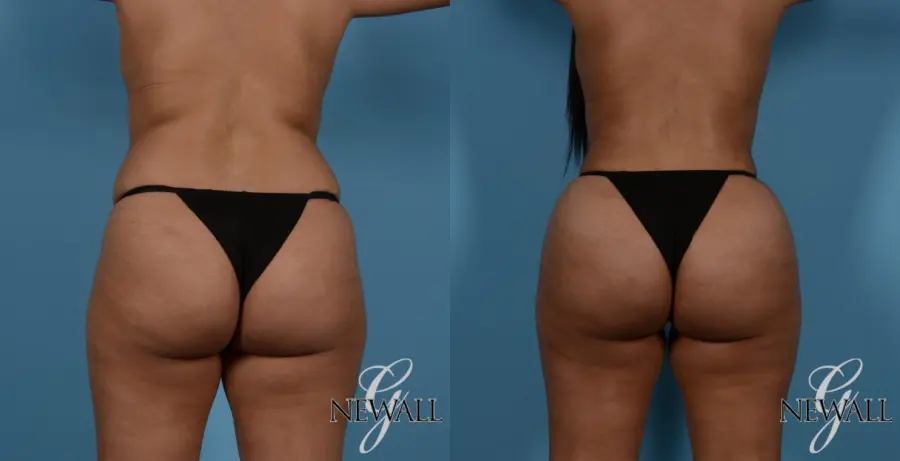 Brazilian Butt Lift: Patient 2 - Before and After  
