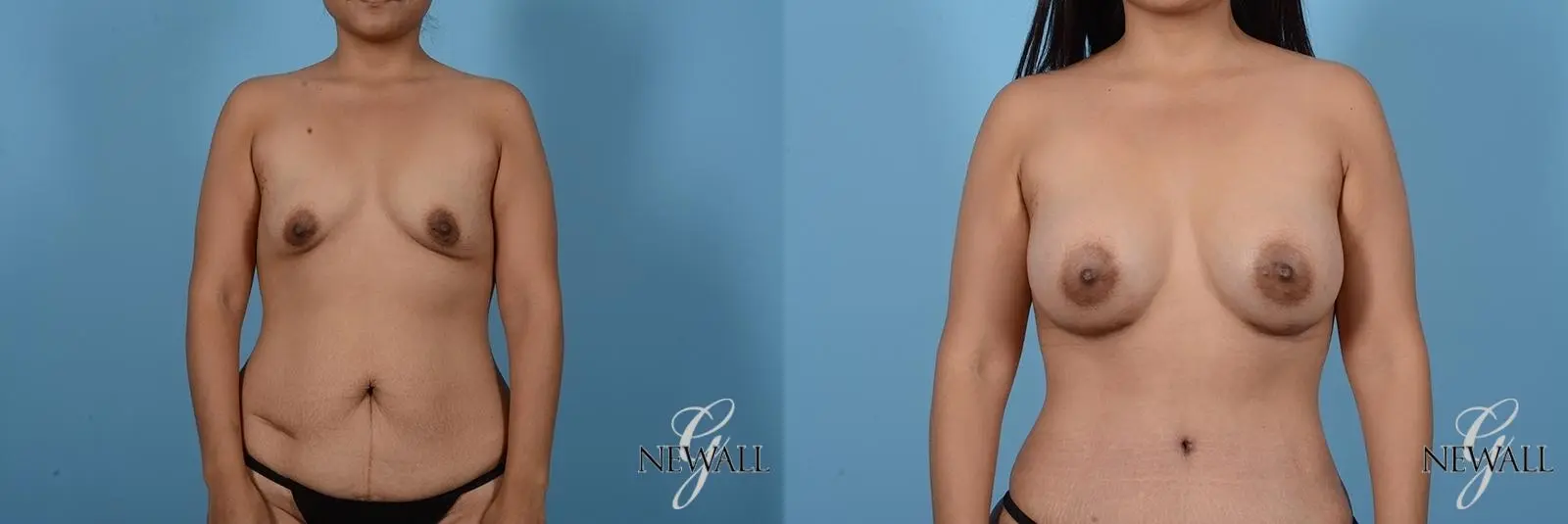 Breast Augmentation: Patient 5 - Before and After  