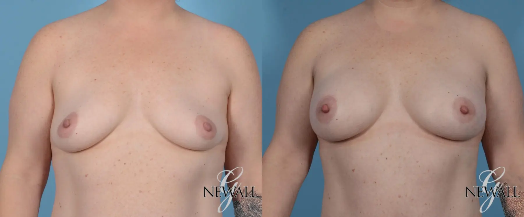 Breast Augmentation: Patient 2 - Before and After  