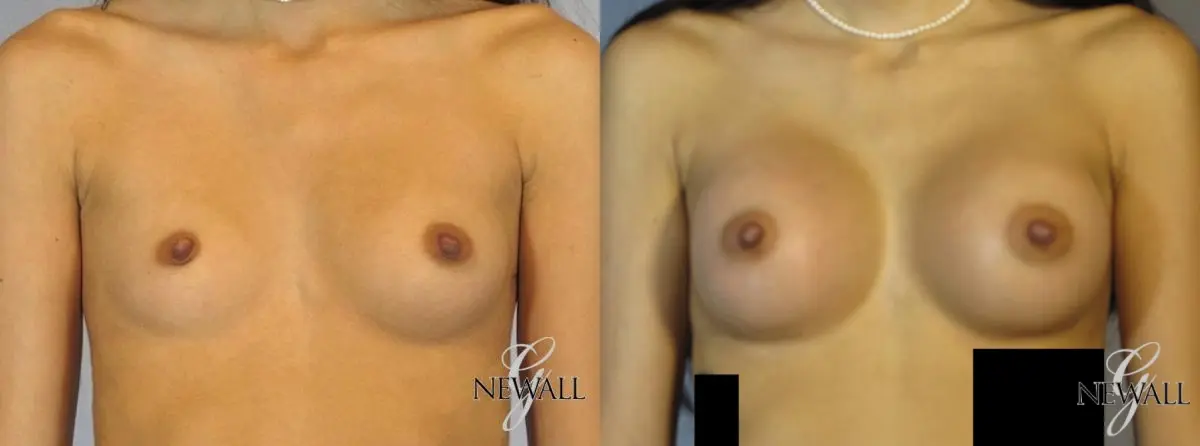 Breast Augmentation: Patient 8 - Before and After  