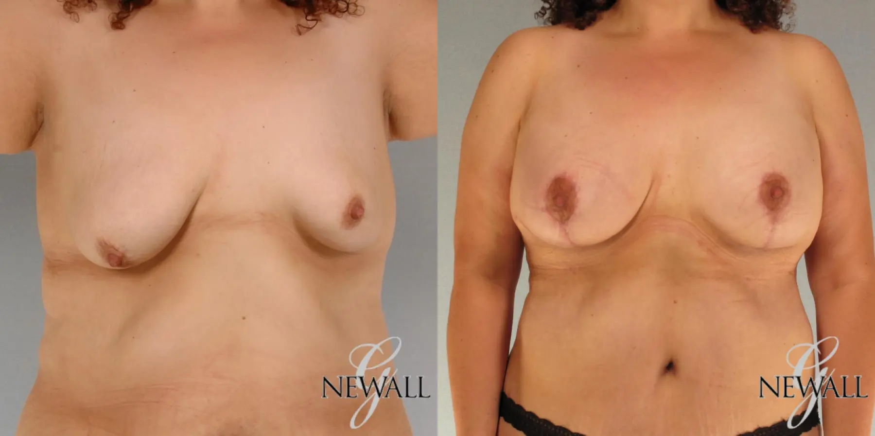 Breast Augmentation With Lift: Patient 1 - Before and After  