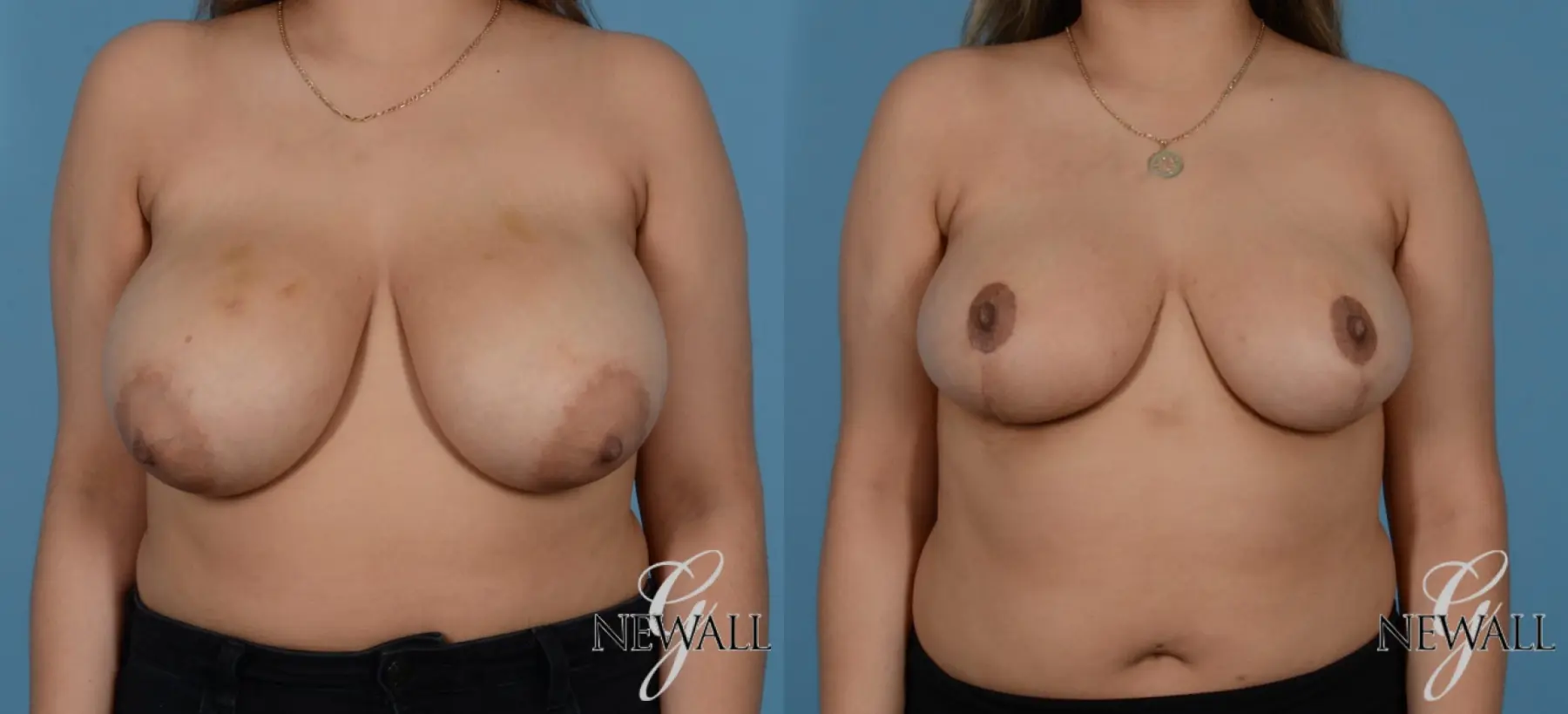 Breast Lift: Patient 1 - Before and After  