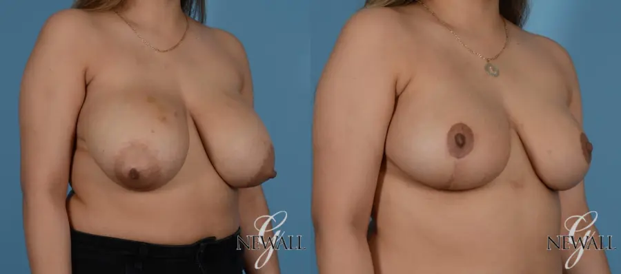 Breast Lift: Patient 1 - Before and After 3