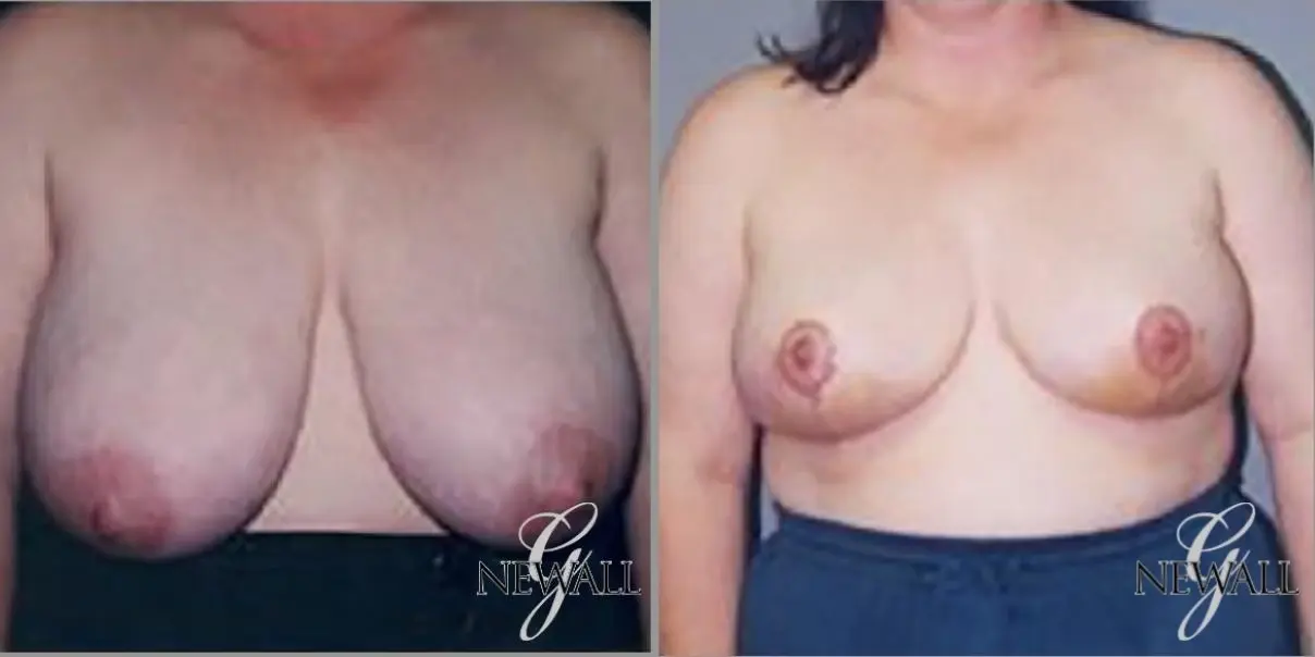 Breast Reduction: Patient 4 - Before and After  