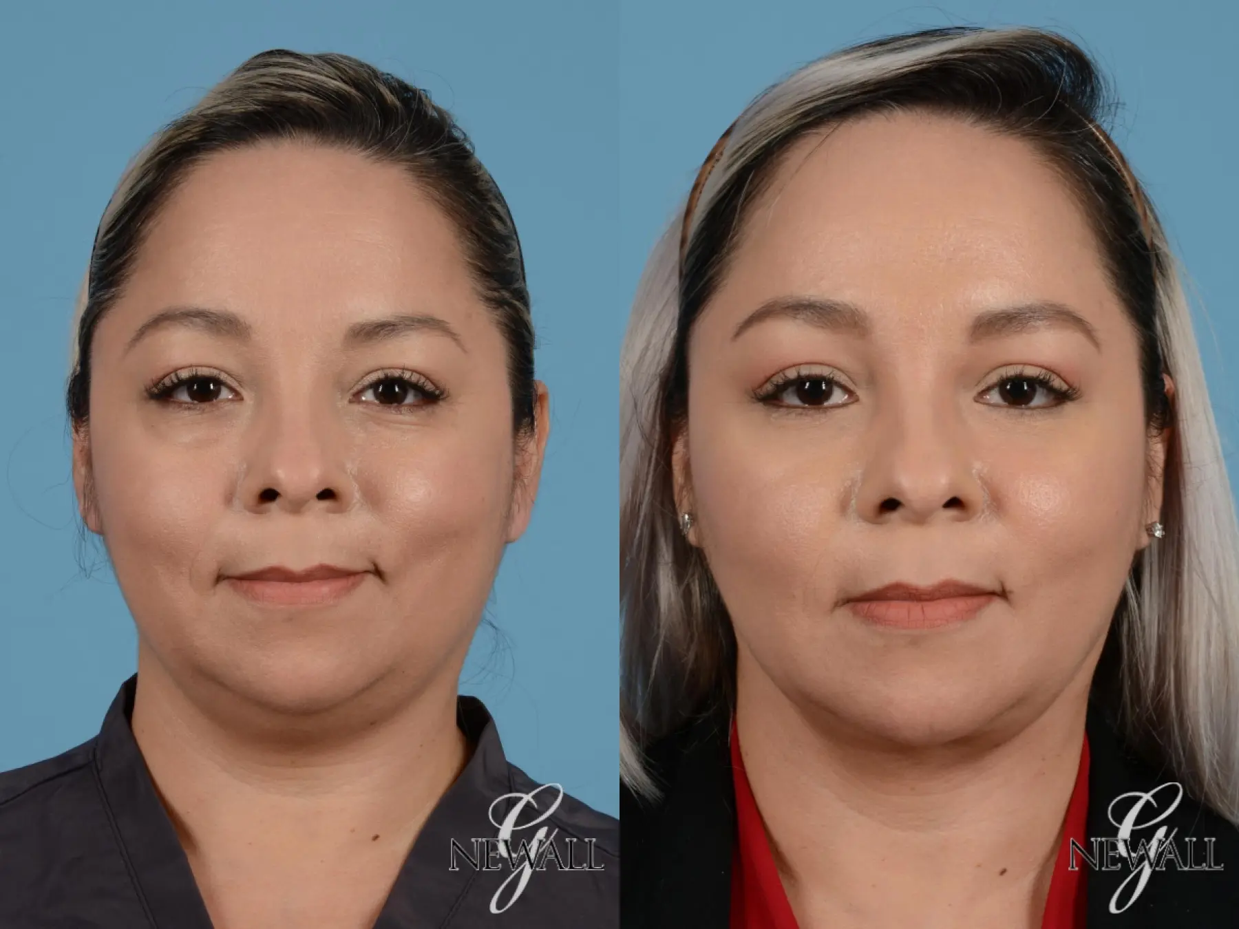 Buccal Fat Removal: Patient 1 - Before and After  