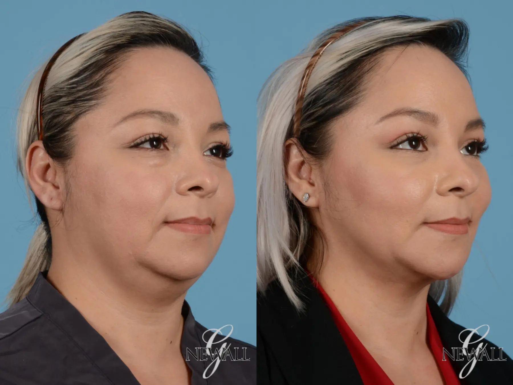 Buccal Fat Removal Before & After Gallery Patient 1