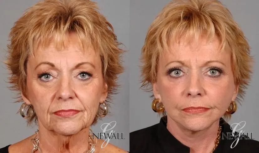 Facelift & Neck Lift: Patient 3 - Before and After  