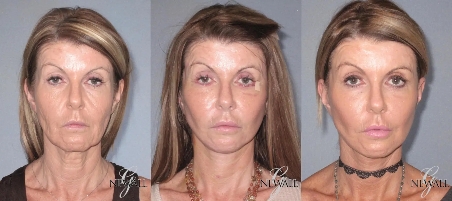 Facelift & Neck Lift: Patient 2 - Before and After  