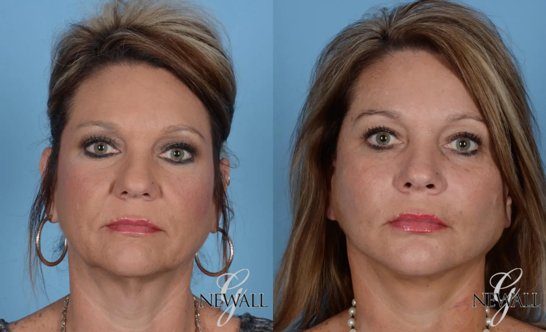 Facelift & Neck Lift: Patient 1 - Before and After  