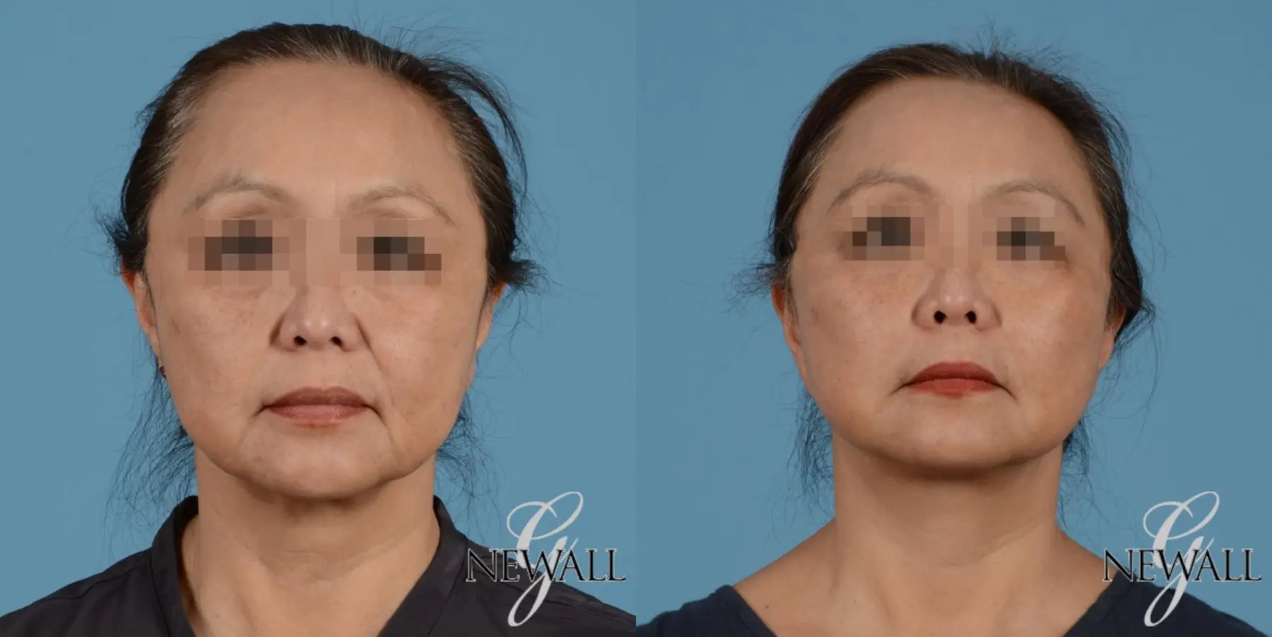 Facelift: Patient 1 - Before and After  