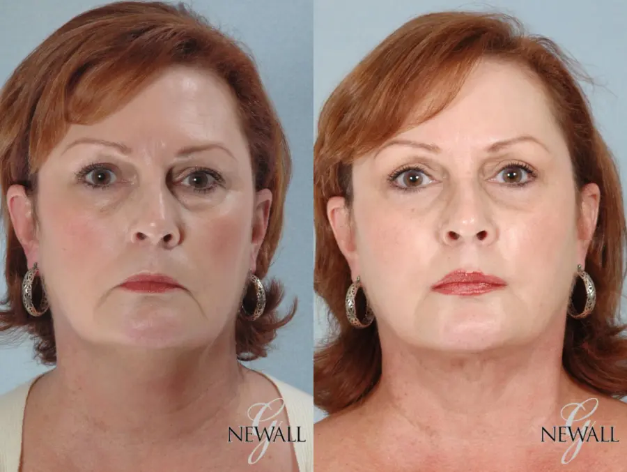 Fat Transfer - Face: Patient 3 - Before and After  