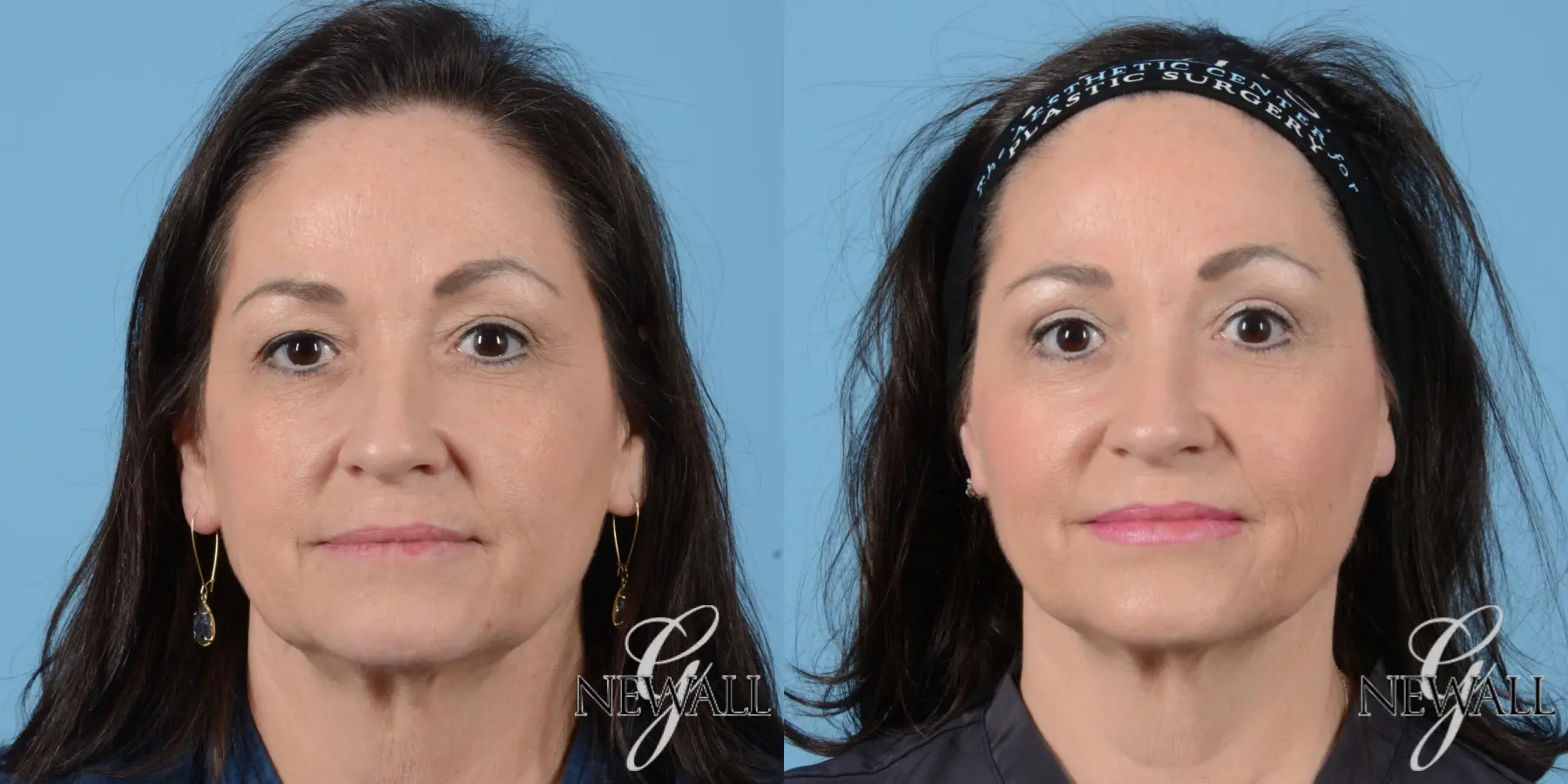 Fat Transfer - Face: Patient 1 - Before and After  