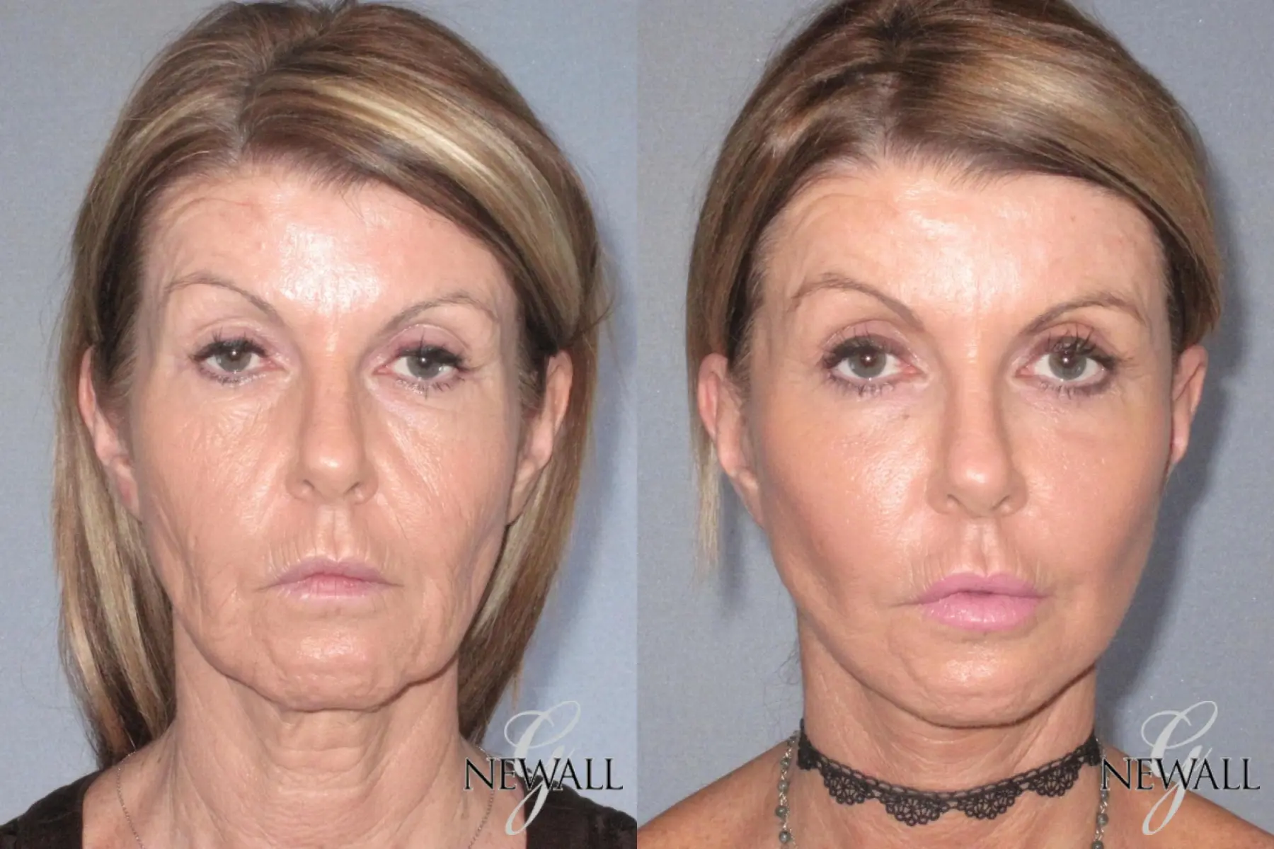 Fat Transfer - Face: Patient 5 - Before and After  