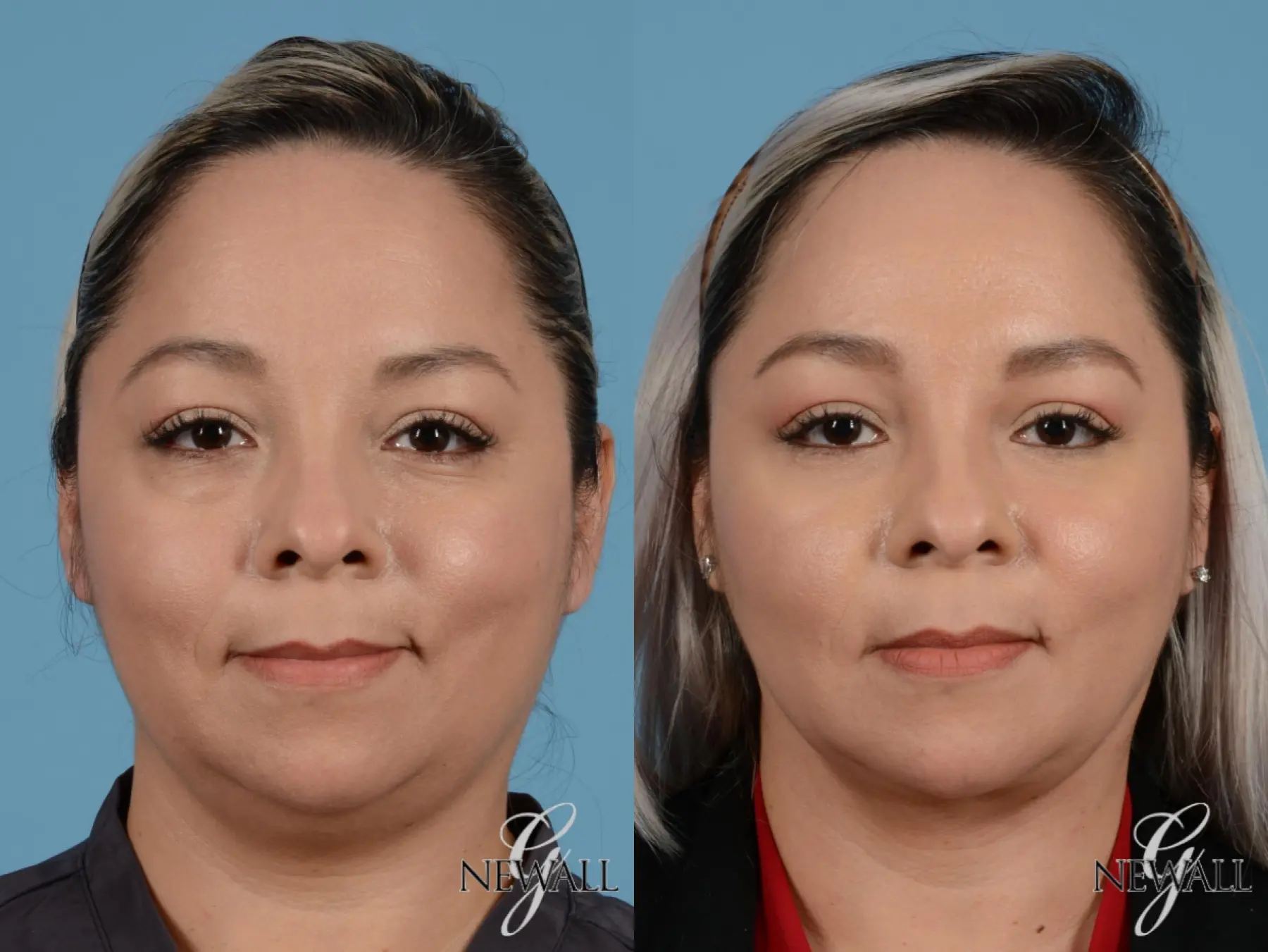 Fat Transfer - Face: Patient 2 - Before and After  