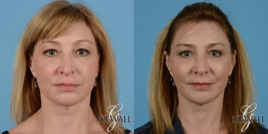 Fat Transfer - Face: Patient 4 - Before and After  